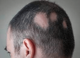 Losing Hair on One Side of the Head