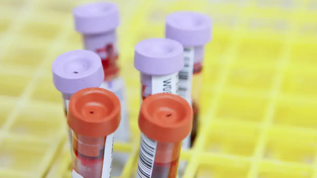 Diagnosing High Hemoglobin and Hematocrit