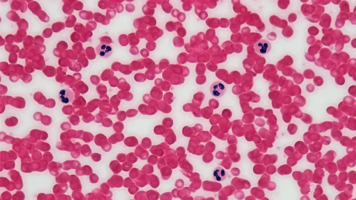Understanding Iron Deficiency and Anemia