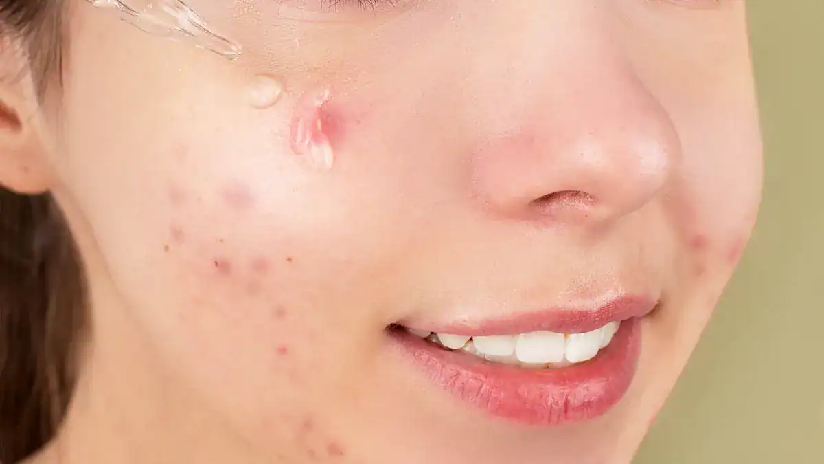 10 Urgent Symptoms of Candida Overgrowth