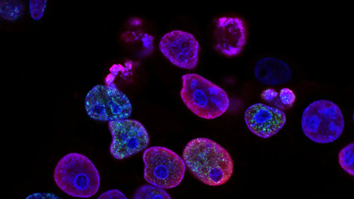 Common Causes of High LDH Levels