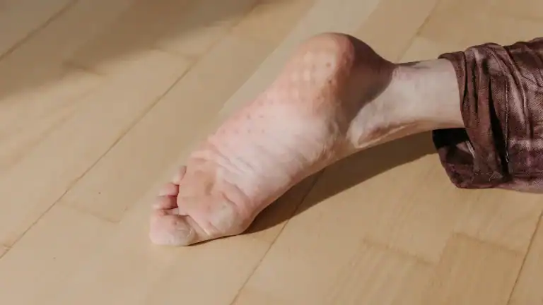 Swelling of One Foot: Causes, Diagnosis, & Treatment