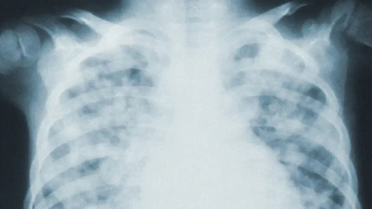 Fluid in Lungs: Causes, Danger