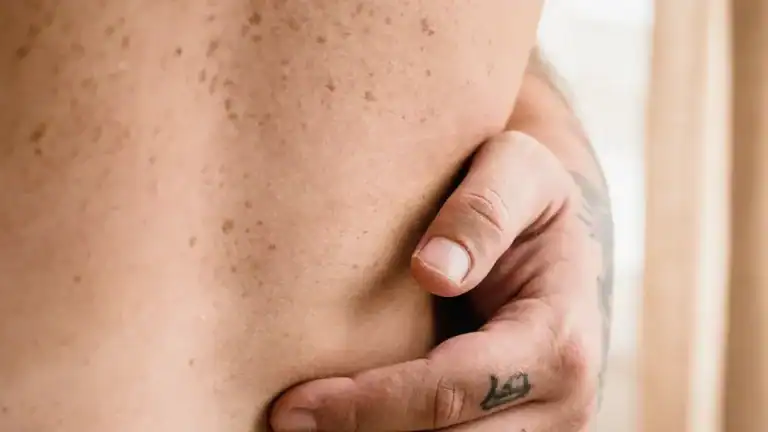 Can You Still Get Shingles If Vaccinated? Truth Revealed