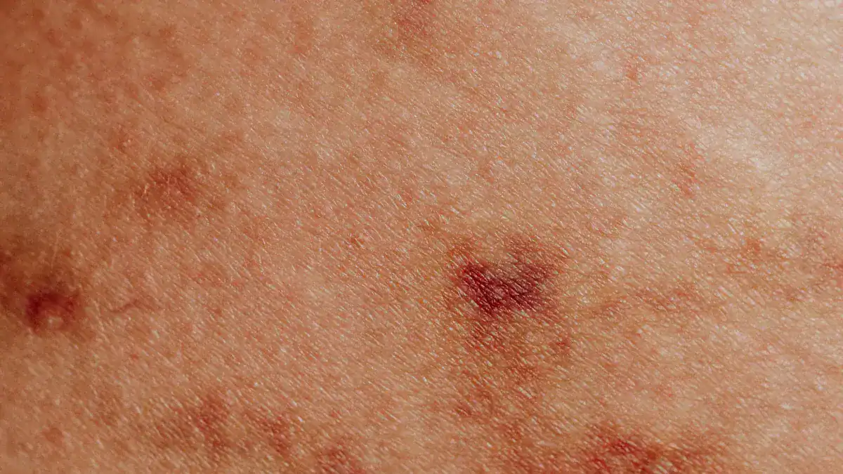 Cellulitis: Bacterial Skin Infection