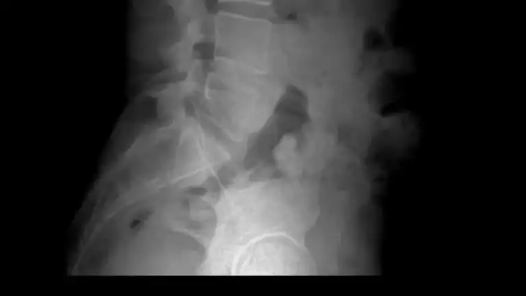 Lumbar Spine and Dermatome Overview