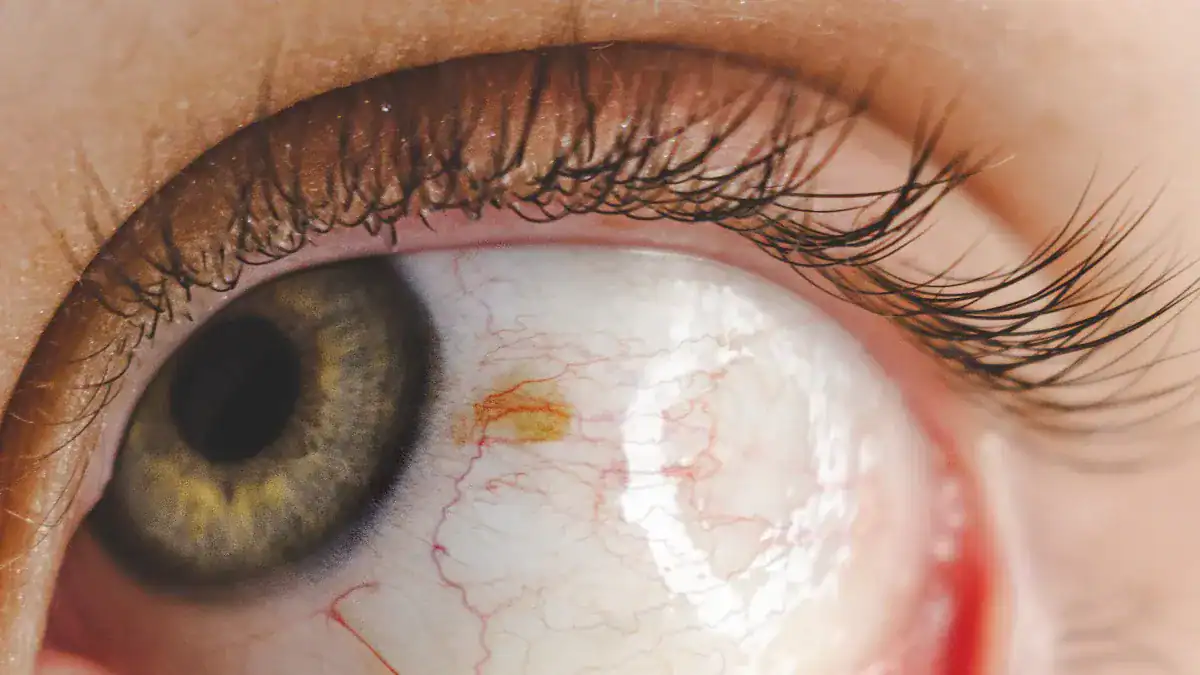 Medical Causes of Right Eye Twitching