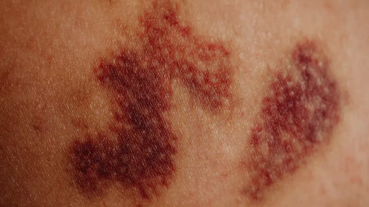 Causes of Lower Leg Redness