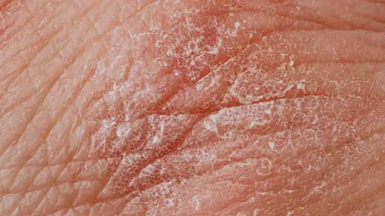 Rashes That Come and Go: Urgent Causes Explained