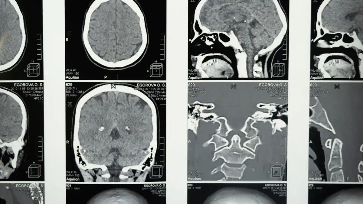 Diagnosing a Brain Burning Feeling