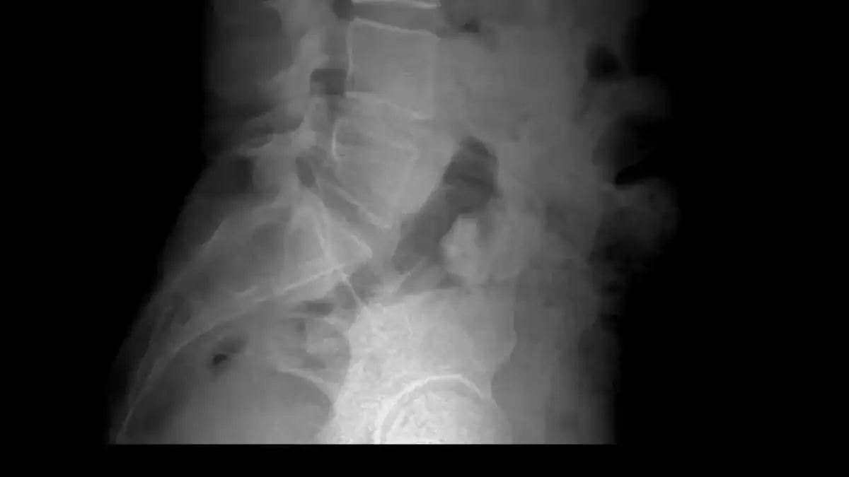 Understanding Herniated Disc