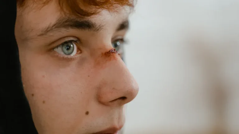 Sudden Upper Lip Swelling: Urgent Causes & Allergy Fix