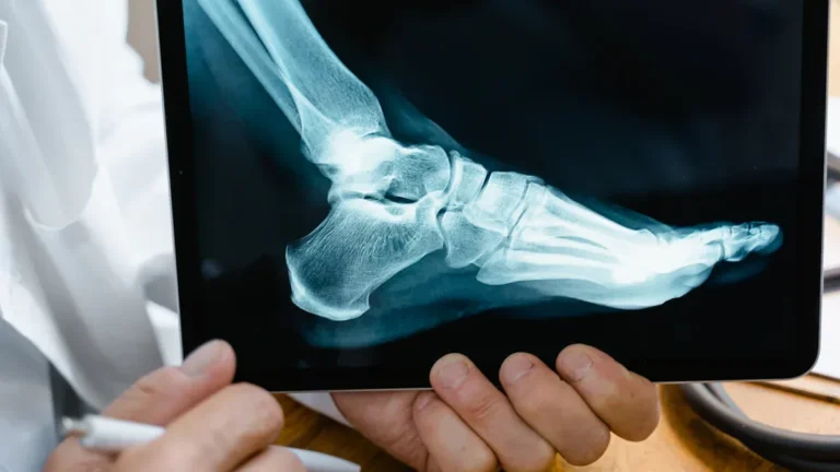 Cuboid Fracture: Symptoms, Diagnosis & Recovery