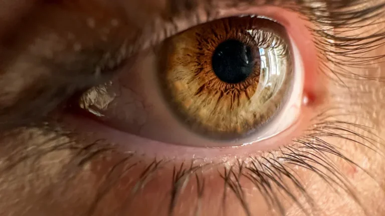 Eye Problems Associated with Hypothyroidism: The Crucial Link